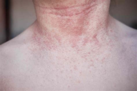 Neck Lump 37 Causes Treatments Pictures Neck Lumps: A Guide To