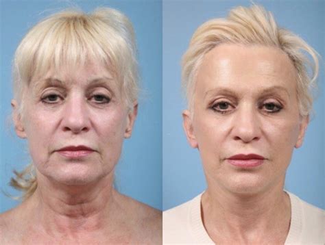 ‘Ozempic® Face’: What To Do About Facial Aging and Sagging Skin After Weight Loss – TLKM Plastic ...