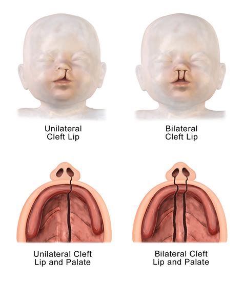 Bilateral Cleft Lip And Palate Accurate Diagnosis Of Prenatal Cleft