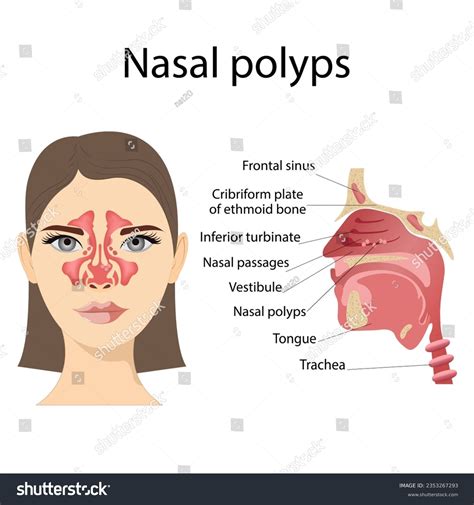 Nasal Polyps Symptoms