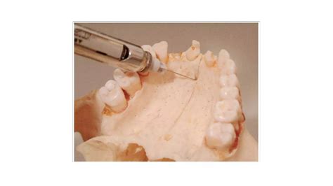 Maxillary Local Anesthesia 的图像结果