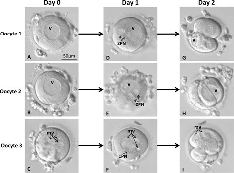 Human oocytes containing large cytoplasmic vacuoles can result in pregnancy and viable offspring ...