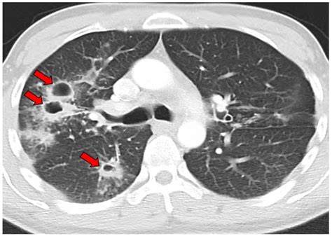 Coccidioidal Pulmonary Cavitation: A New Age