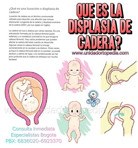 Pin en Clínica Displasia Cadera Niños