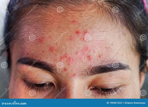 Closeup Acne on Forehead of Asian Woman Teen, Face with Rash Skin Allergic To Cosmetics Stock ...