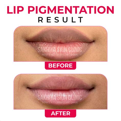 Lip Pigmentation: Causes, Treatments, and Prevention