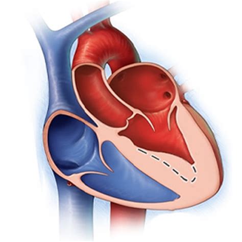 atrial septal defect treatment & management | asd