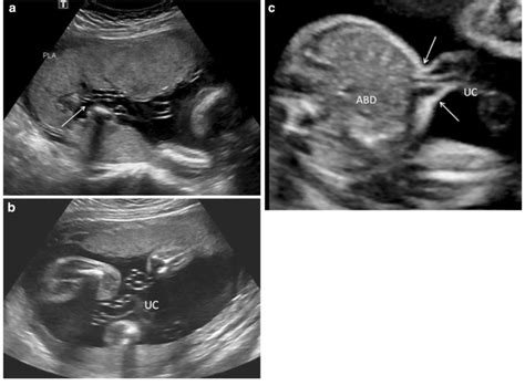 Bildergebnis für normal umbilical cord ultrasound