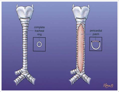 Figure 9 from A history of pediatric tracheal surgery. - Semantic Scholar
