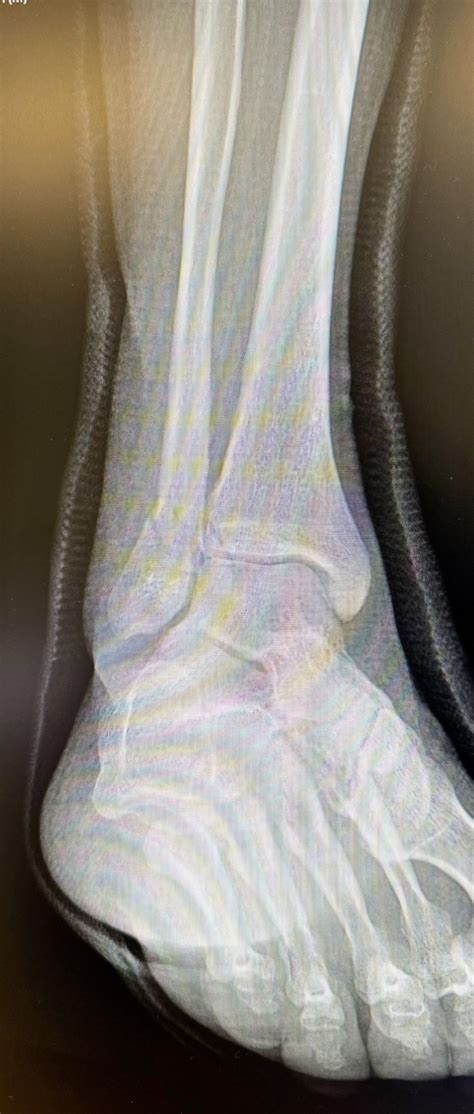 Ankle fracture healing time experience? : r/brokenbones