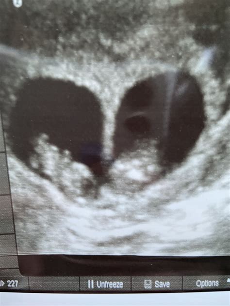 9 week twins ultrasound | Twins ultrasound, Twins, Ultrasound
