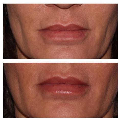 Lip Filler Before and After Pictures - Boise, Idaho