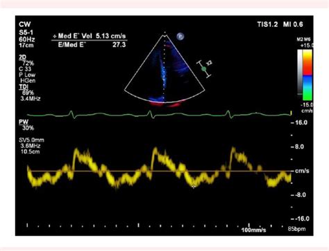 Image result for Moderate Diastolic Dysfunction