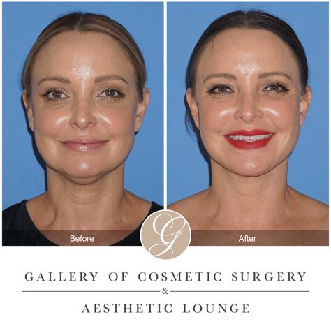 Buccal Fat Removal Egypt at Ella Hogarth blog