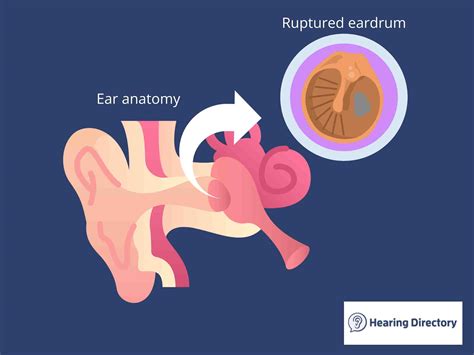 Ruptured Eardrums and Hearing Loss: Causes, Signs, and Treatment