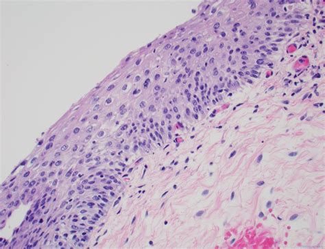 Que Significa Low Grade Intraepithelial Lesion at Brandon Myers blog