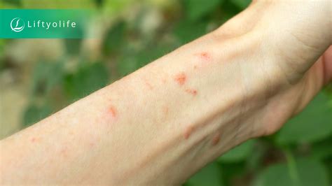 Is Poison Ivy Contagious After Its Dead at Loretta Little blog