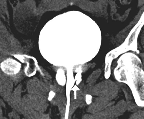 Urethral Diverticulum: Diagnosis with Virtual CT Urethroscopy | AJR