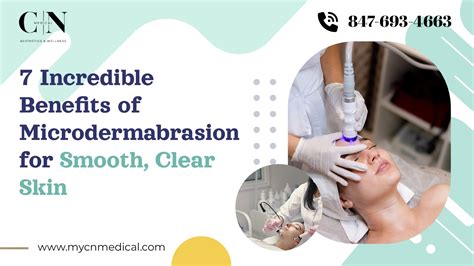 7 Microdermabrasion Benefits for Smooth and Clear Skin