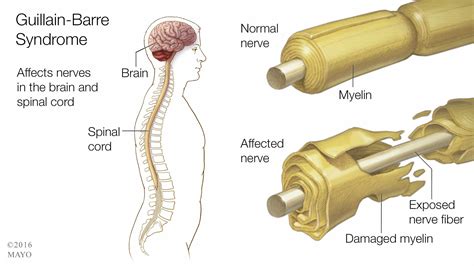 Guillain-Barre Syndrome and Zika: Is There a Connection? - Mayo Clinic News Network