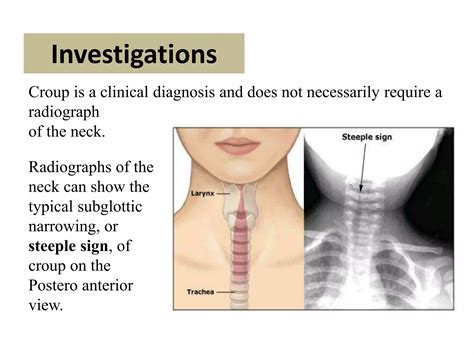 An approach to a case of Paediatric Stridor | PPTX