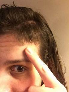 Baby Hair Fall Out Grow Back by Why Your Hair Is Falling Out After Pregnancy Midwife And Baby Hair Fall Out Grow Back
