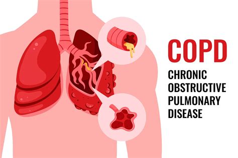 Chronic Obstructive Pulmonary Disease Causes