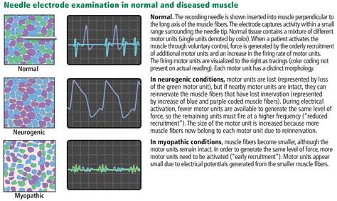 What Is A Ncs/Emg Test at Kevin Davidson blog