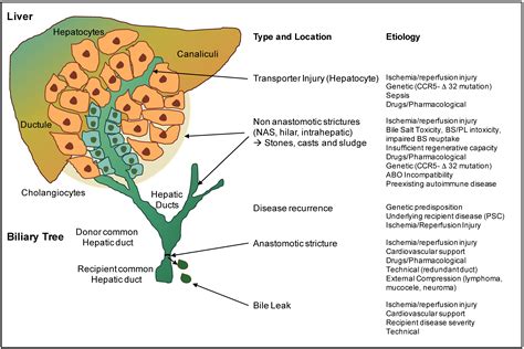 Impact of Machine Perfusion on Biliary Complications after Liver ...