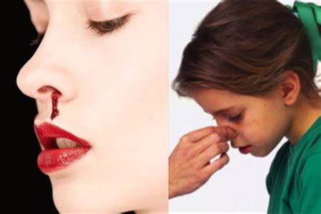【鼻子】【图】鼻子出血是什么原因 我们该如何预防_伊秀健康|yxlady.com