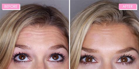 What to Know About Forehead Botox Before and After - The Source Full