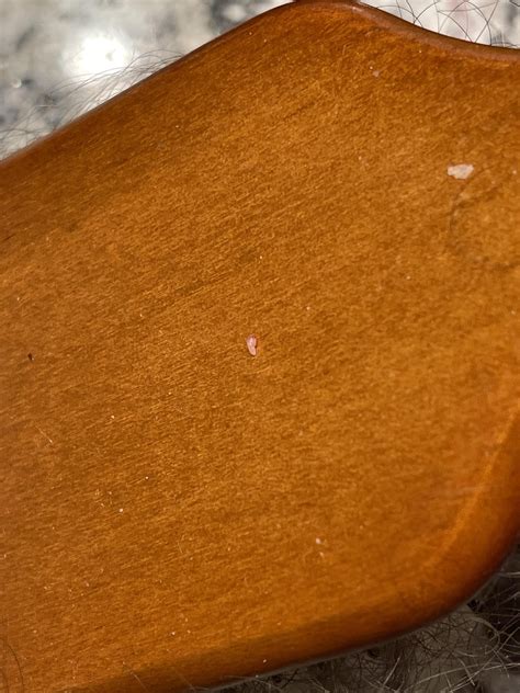 White Spots On Labia _ Lichen Sclerosus: Symptoms, Causes, Treatment – ETDKHL