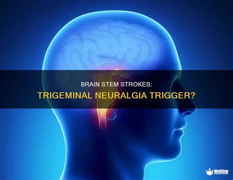 Brain Stem Strokes: Trigeminal Neuralgia Trigger? | MedShun