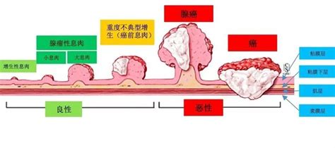 关于大肠癌---您了解多少？