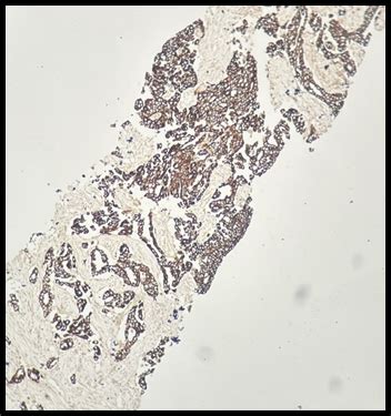 Utility of immunohistochemistry with CK7 and CK20 in metastatic ...
