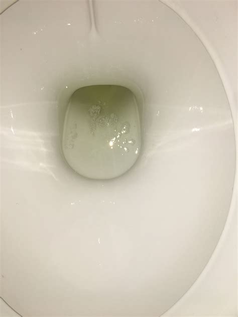 Ask a Pediatrician Online for Bubbles In Urine