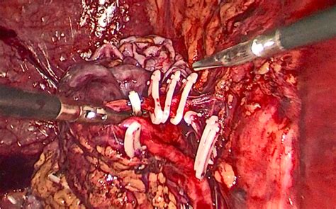 一粒输尿管结石的疏忽足以毁了整个肾脏 - 微医（挂号网）