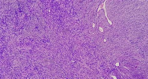 Premium Photo | Photomicrograph of schwannoma a benign soft tissue tumor of peripheral nerve sheath