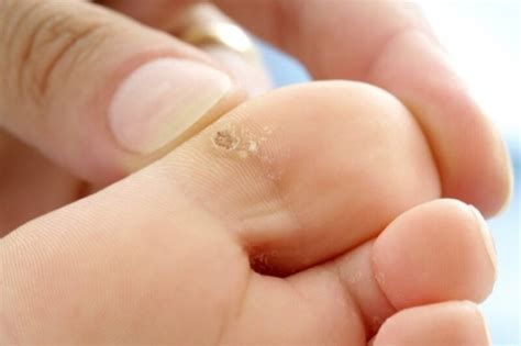 cara mengobati sakit mata ikan di kaki