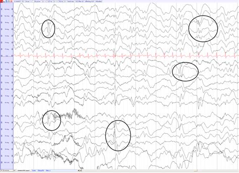 West Syndrome (Infantile Spasm) - EEGpedia
