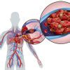 Emboli Paru - patofisiologi, diagnosis, penatalaksanaan - Alomedika