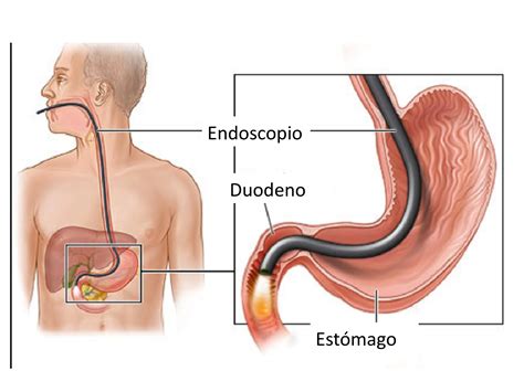 Gastroscopia: qué es , cómo se hace, para qué sirve - Dr Onofre Alarcón. Médico Especialista ...