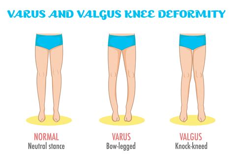 Varus Vs Valgus