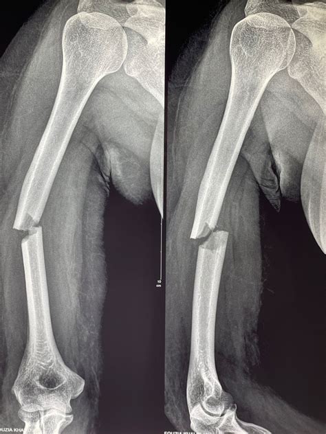 Humeral Shaft Fractures | Treatment & Management | Point of Care
