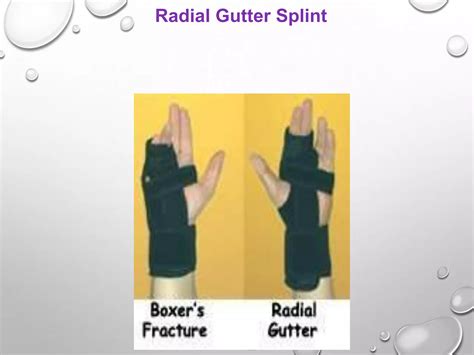 Splint ppt by rupeshkumar | PPTX