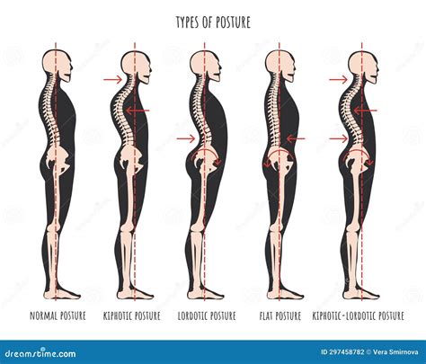 Type of Posture, Postural Syndromes Infographic. Skeletal Samples of ...