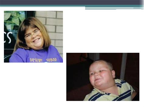 Síndrome de Laurence Moon-Bardet-Biedl | PPTX