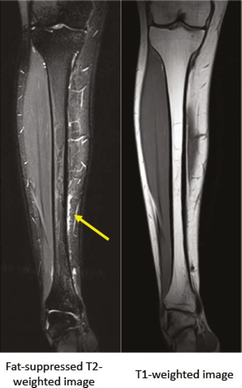Medial Tibial Stress Fracture