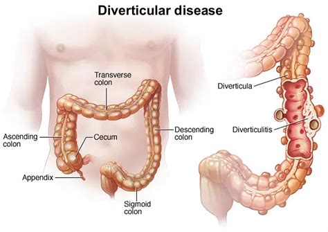 Diverticular disease, causes, symptoms, diagnosis & treatment