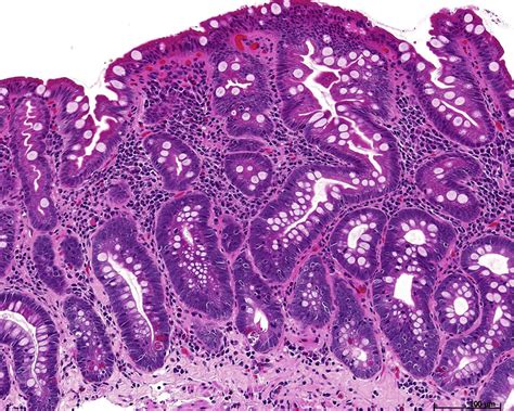 Histologic intestinal metaplasia and endoscopic atrophy are predictors of gastric cancer ...